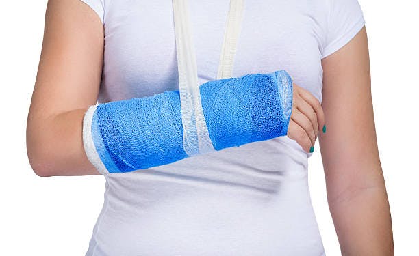 Arm in a cast and sling